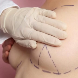 عملية تجميل الثدي ورفعه